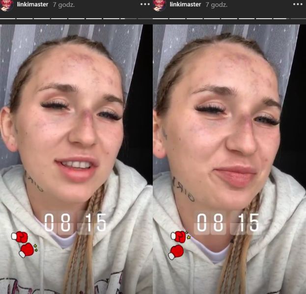 Dumna Marta Linkiewicz pokazała twarz po walce z Sex Masterką Nigdy tak zaje ście nie