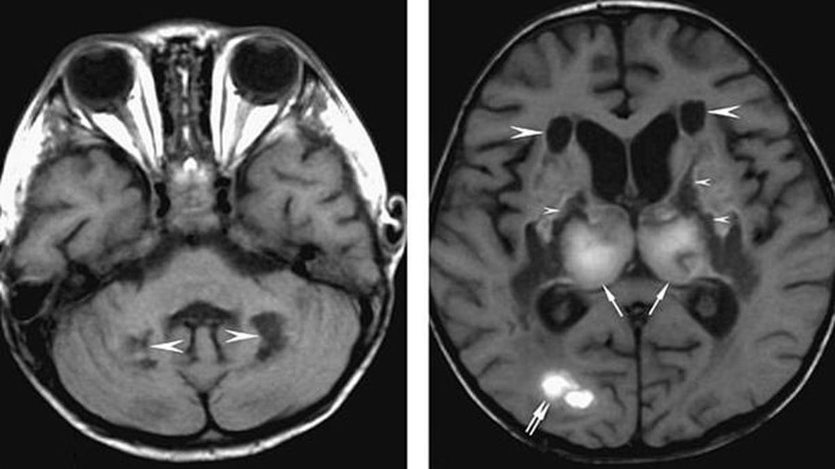 Koronawirus. Odkryto nowe skutki zarażenia