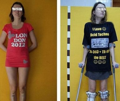 Marzyła o tym, by zostać modelką, ale była za niska. Wydłużyła nogi operacyjnie