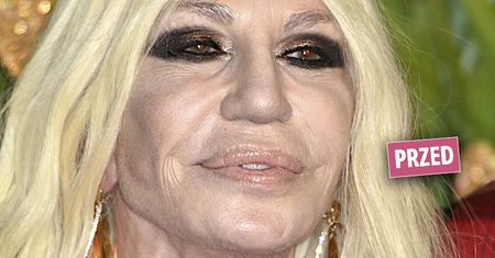 Donatella Versace "zmieniła" twarz! Po operacji odmłodniała o 20 lat! Cały świat zachwyca się tym, jak cudnie wygląda!