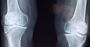 Leczenie złamanych kości będzie łatwiejsze. Nowy sposób z wykorzystaniem druku 3D