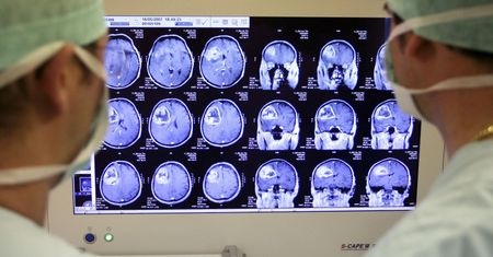 Życie z połową mózgu jest możliwe. Może też być całkiem normalne