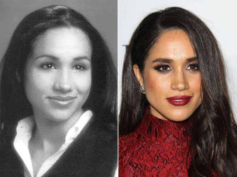 Meghan Markle przed i po operacji plastycznej