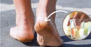 Na popękane pięty robię domowy okład. Kosztuje mniej niż 5 złotych, a wyglądają jak po SPA