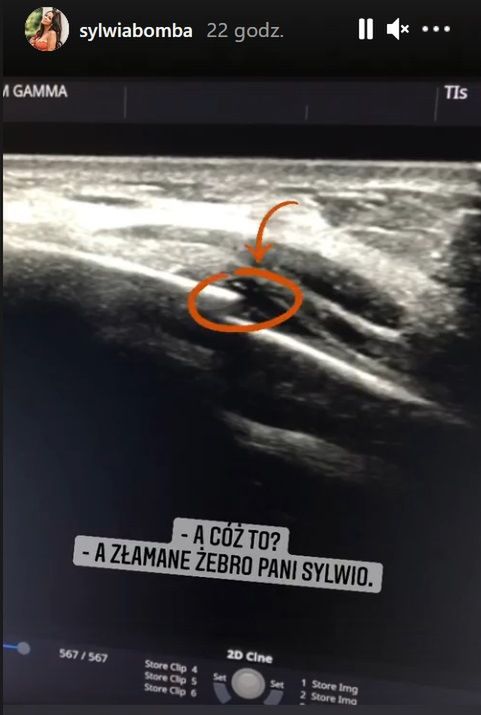 Sylwia Bomba ma pęknięte żebra