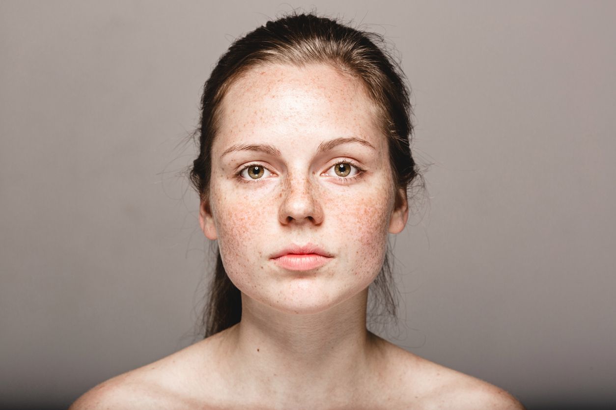 Przebarwienia na twarzy - jak zlikwidować plamy, piegi i ostudy