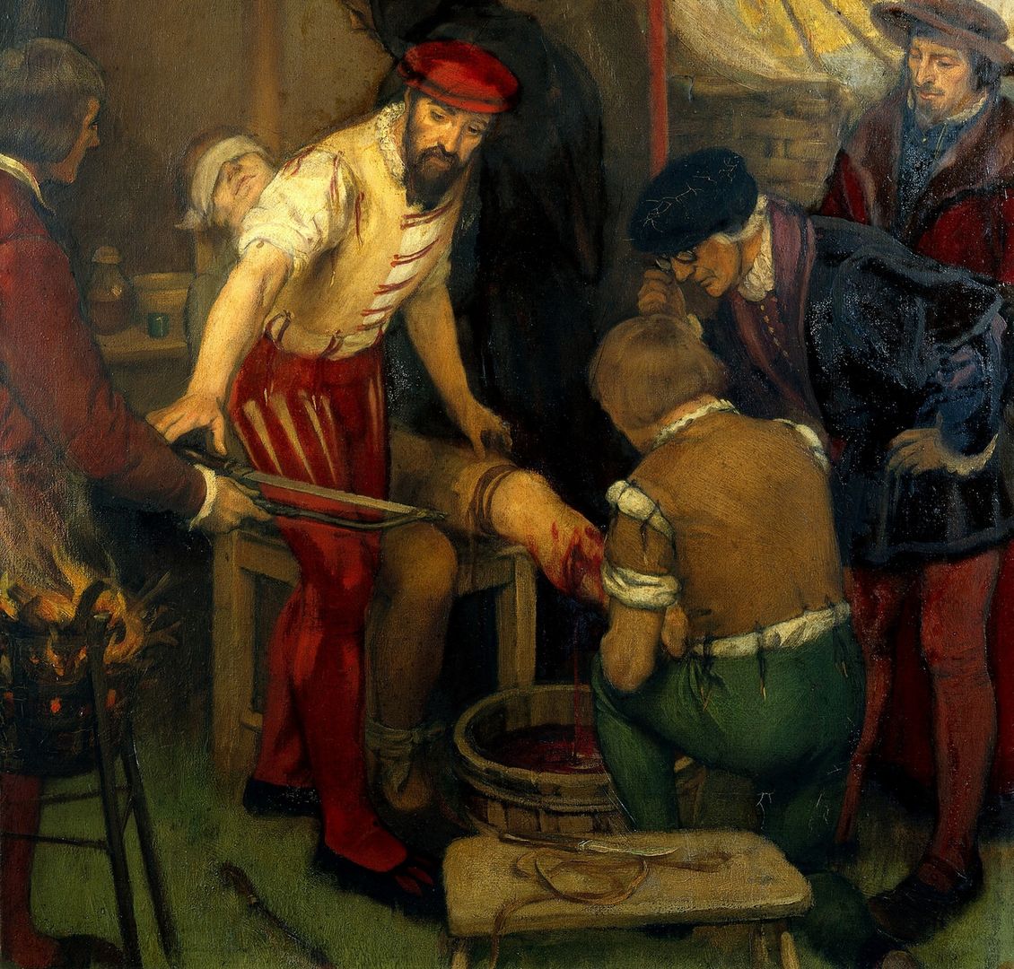 Ambroise Paré (na ilustracji szykuje się do amputacji nogi pacjenta) miał wiele intrygujących pomysłów na temat właściwości „leczniczych” metali ciężkich i… odchodów