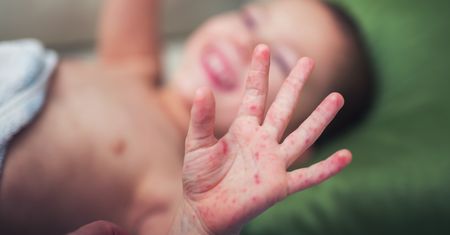 Odra w Polsce: czy to już epidemia? Brakuje szczepionek
