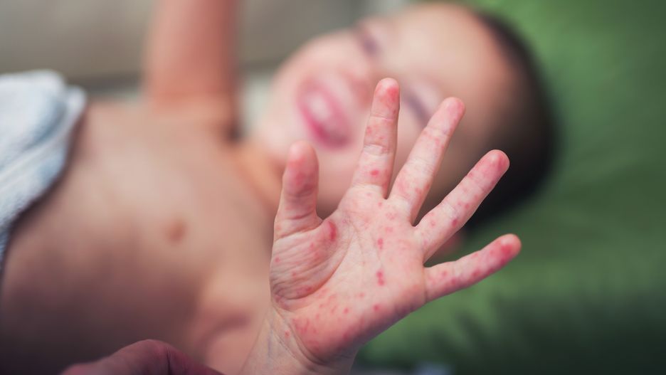 Odra w Polsce: czy to już epidemia? Brakuje szczepionek