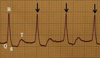 Zdjęcie zapisu EKG 
