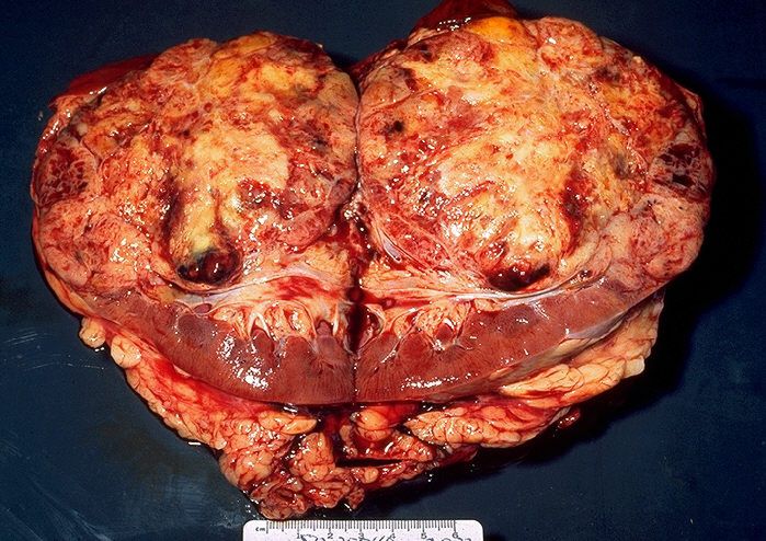 Zdjęcia raka nerki 