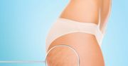 Cellulit: pomarańczowa skórka — jak się jej pozbyć?