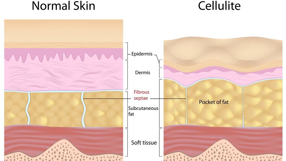 Skóra normalna kontra skóra z cellulitem