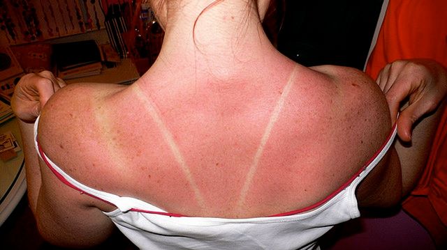 Poparzenia od słońca mogą objawiać się zaczerwienieniem, tkliwością, świądem skóry czy pękającymi pęcherzami.