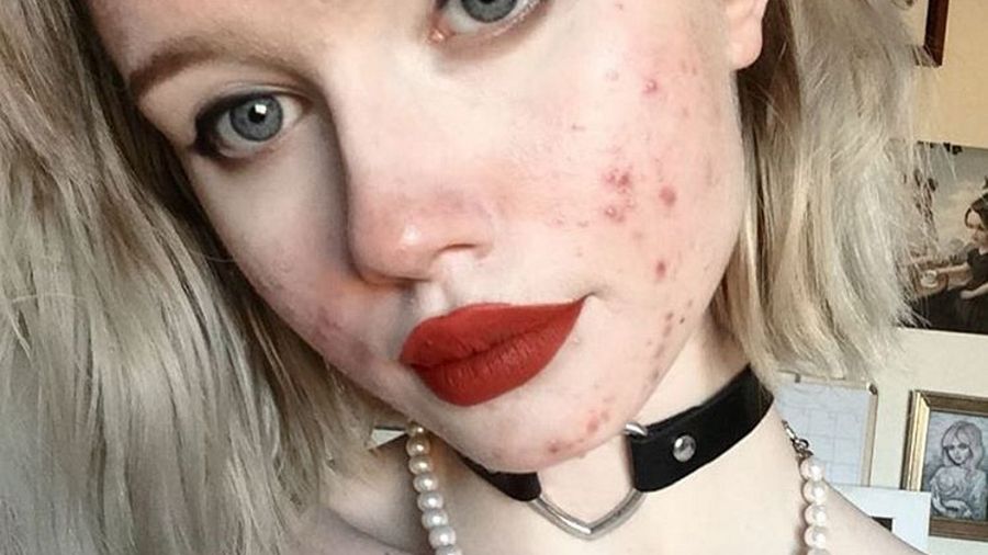 Hailey nie boi się pokazywać trądziku 