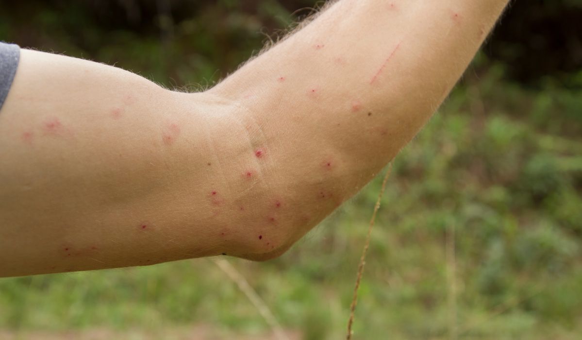 Ukąszenia komarów zostawiają bolesne bąble i rany - Pyszności; Fot. Adobe Stock
