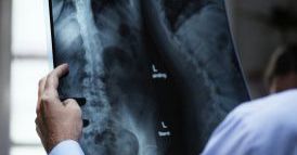 Materiał imitujący ludzką kość będzie ratunkiem dla osób zagrożonych amputacją