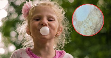 Połykanie gumy do żucia szkodzi? To zdjęcie ze szpitala mówi samo za siebie