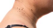 Czerniak u osób z mniejszą liczbą znamion bardziej agresywny