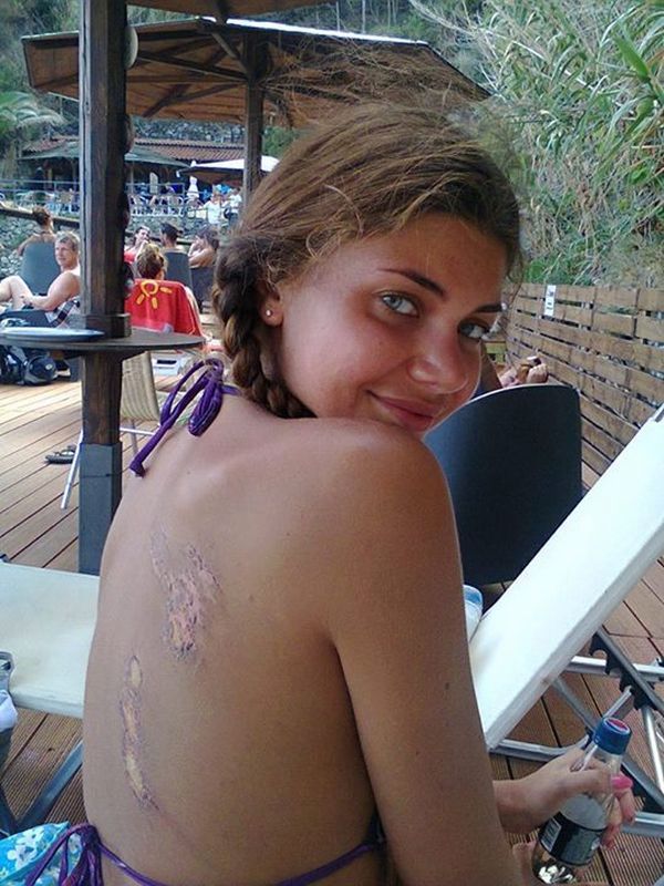 Wodzianka: wypadek na skuterze i poparzenia słoneczne. Dosłownie!