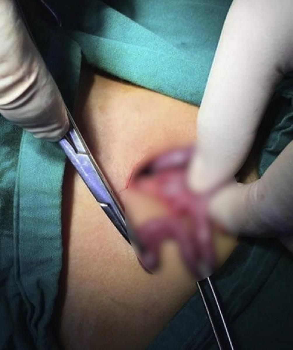 Dziecko połknęło gwóźdź