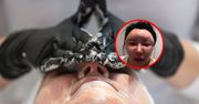 "Bubble face" podbija internet. Lekarz ostrzega: Pojawiają się deformacje i guzy