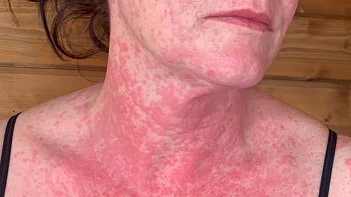 41-letnia kobieta została zaszczepiona 2 tygodnie temu 