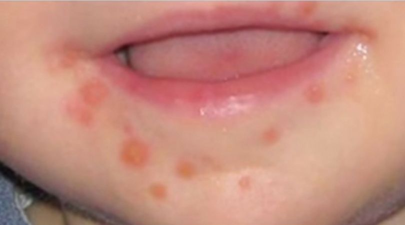 Choroba dłoni, stóp i jamy ustnej (HFMD)