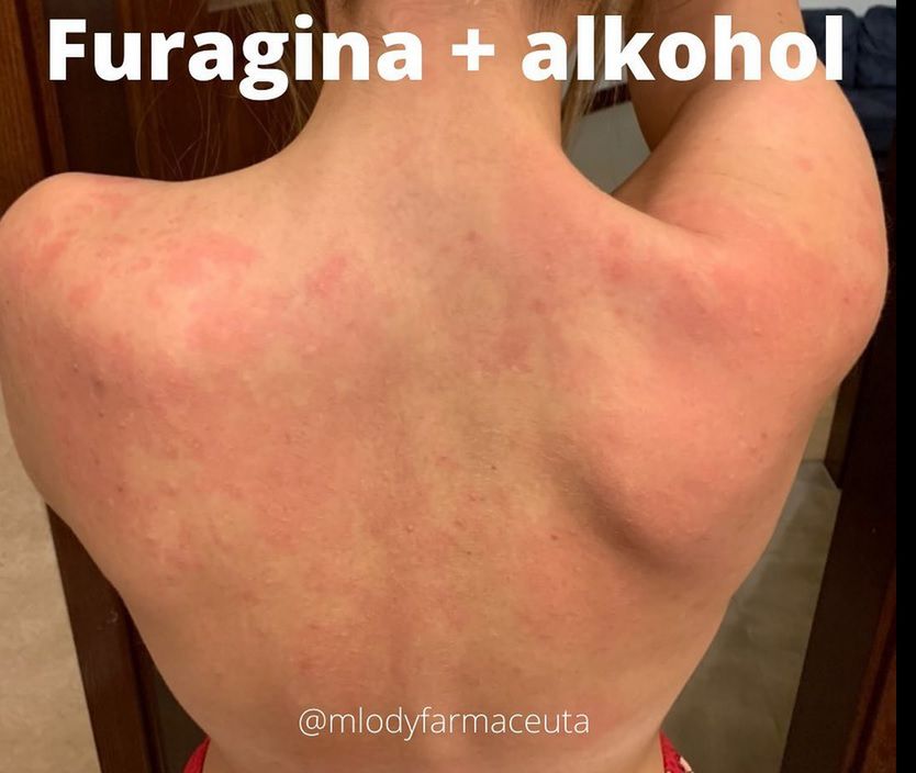 Wysypka może być jedną z konsekwencji łączenia furaginy z alkoholem