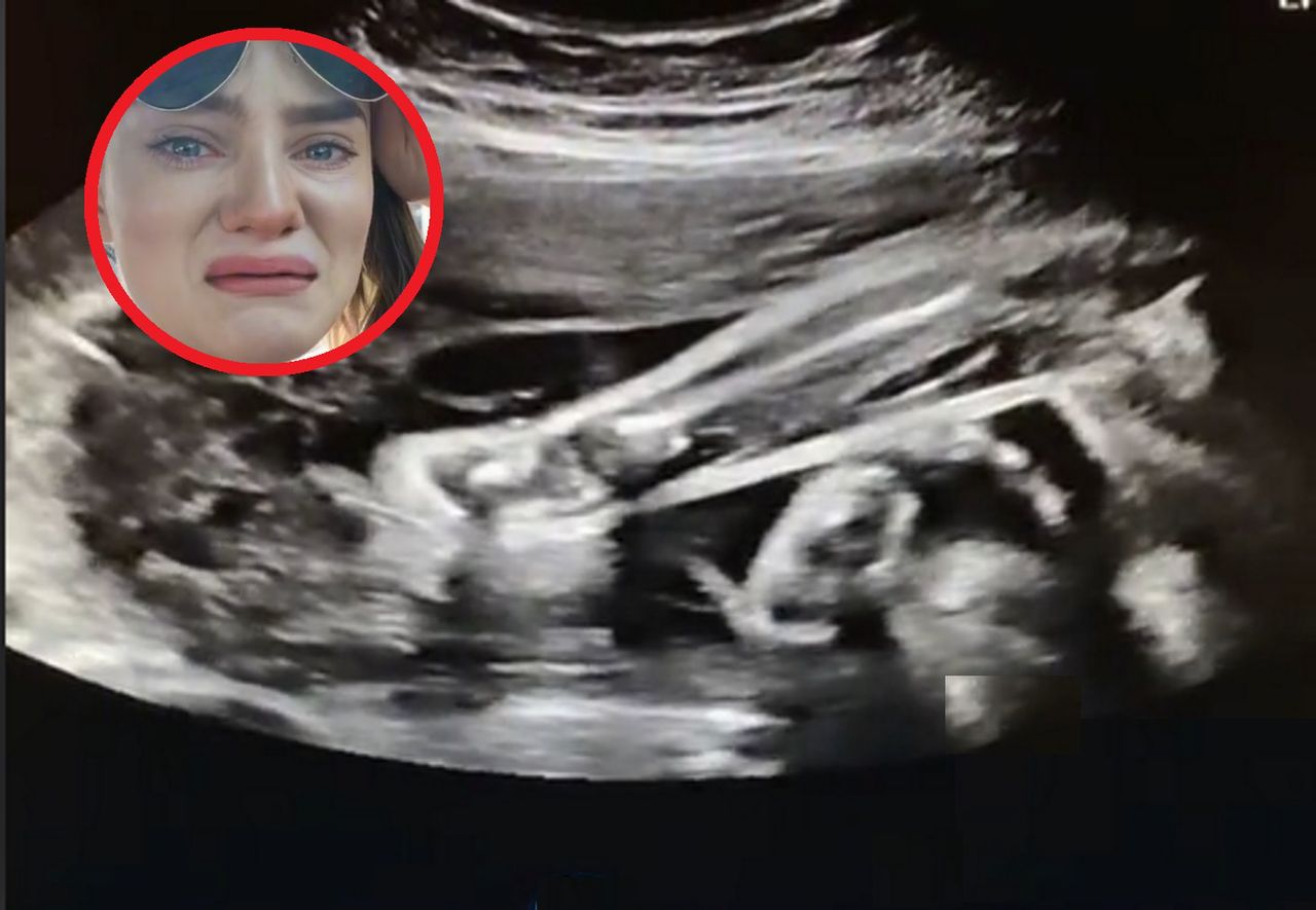 Wciąż chciało jej się siku. USG rozwiało wszelkie wątpliwości