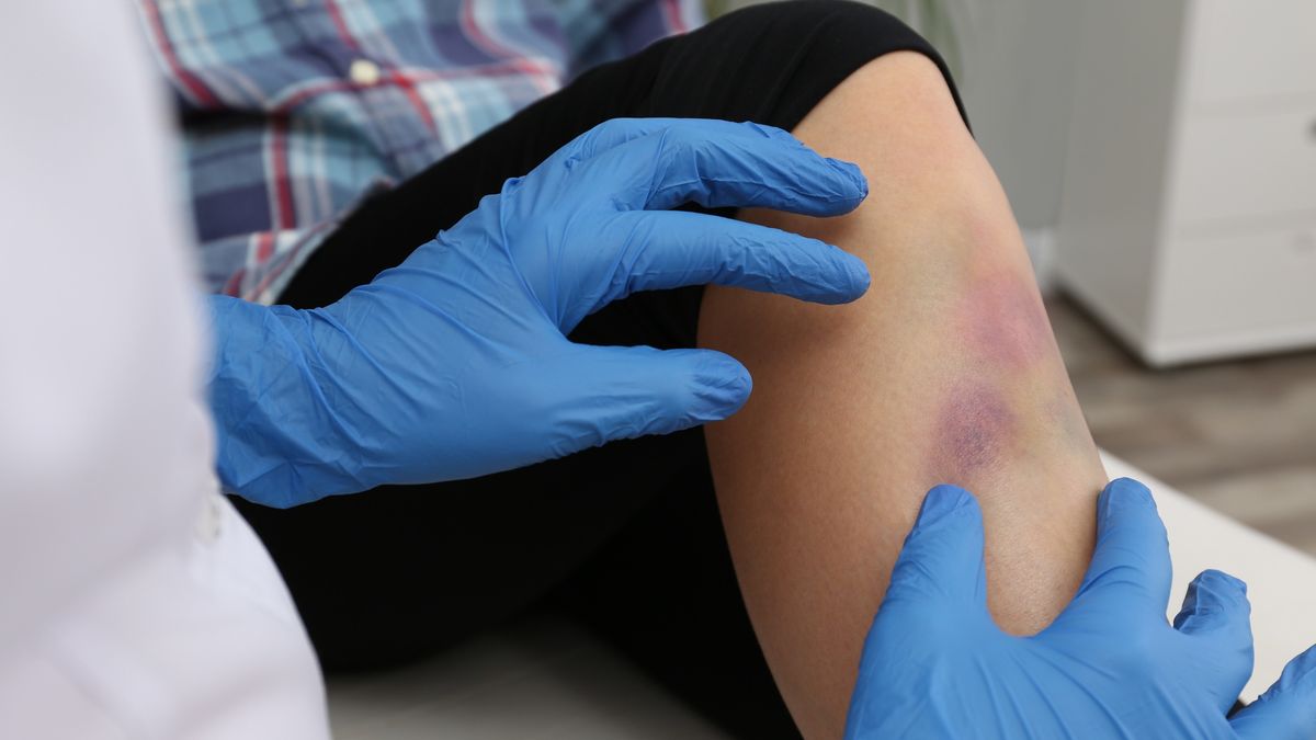 Doctor checking boy's leg with bruise at hospital, closeup
Doctor checking boy's leg with bruise at hospital, closeup
Liudmila Chernetska
closeup, checking, boy, gloves, background, woman, female, health, therapy, treatment, treat, kid, little, help, medical, hurt, clinic, injury, trauma, physical, beat, accident, medic, injured, bruised, palpation, body, preschooler, beaten, tissue, hematoma, contusion