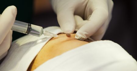 Straciła wzrok po podaniu kwasu hialuronowego. To pierwszy taki przypadek w Polsce