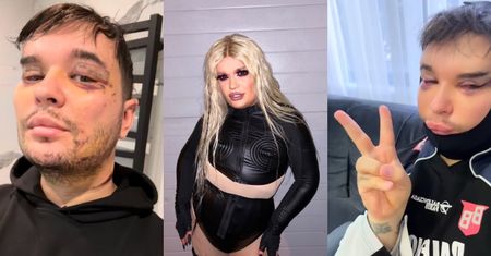 Drag queen Filo relacjonuje pierwszą operację plastyczną w Turcji. "Ale będę kicia"