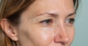 Co zrobić z opadającą powieką? Ekspertka podzieliła się radami