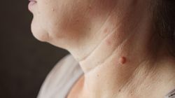 Atakuje Polaków częściej niż czerniak. Objawy raka są charakterystyczne