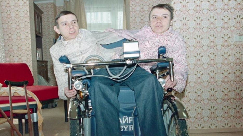 Bliźniaczki syjamskie z ZSRR