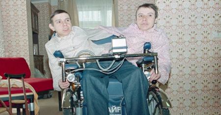 Bliźniaczki syjamskie z ZSRR. Masza i Dasza zostały okaleczone przez lekarzy