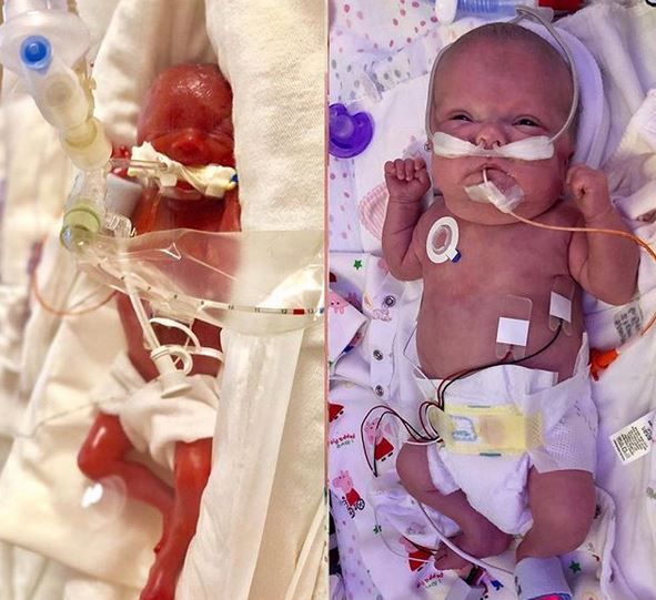 Po 3 miesiącach dziewczynka jest już w lepszym stanie