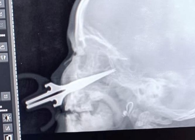 Lekarze usunęli nożyczki z twarzy pięciolatki