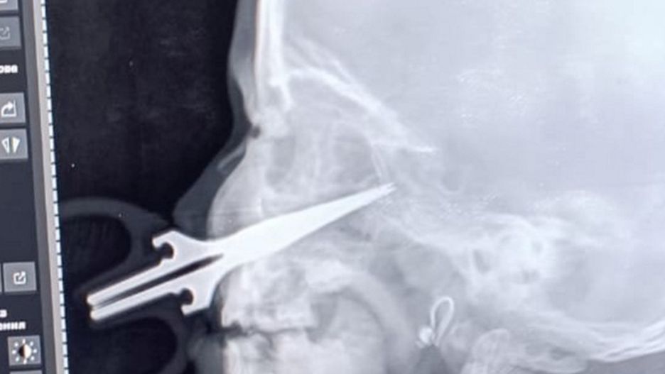 Lekarze usunęli nożyczki z twarzy pięciolatki