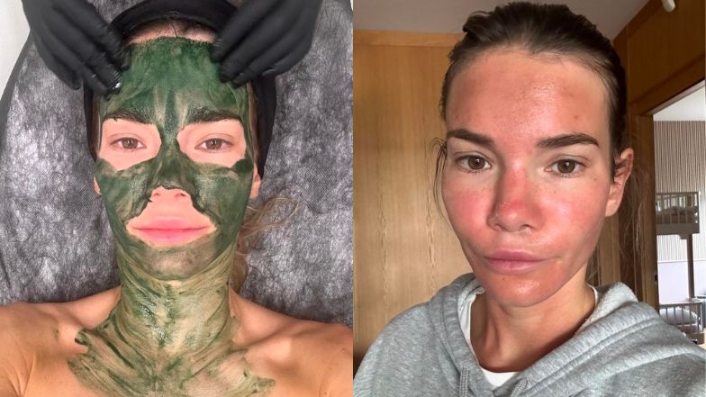 Maja Bohosiewicz zdecydowała się na bolesny zabieg