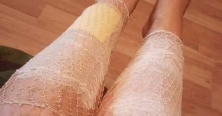 Depilacja IPL poparzyła jej skórę. Przed nią pół roku leczenia