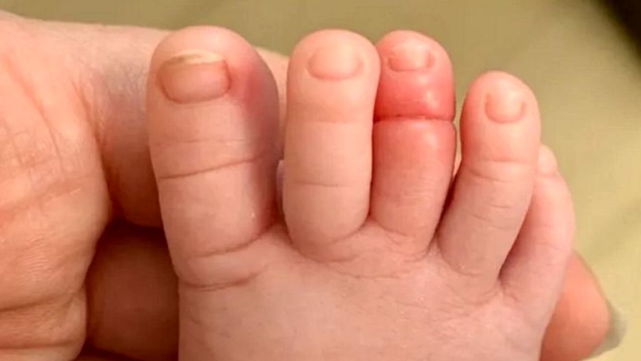 Odkryła, że palec synka jest silny i opuchnięty. Wszystko przez jeden włos