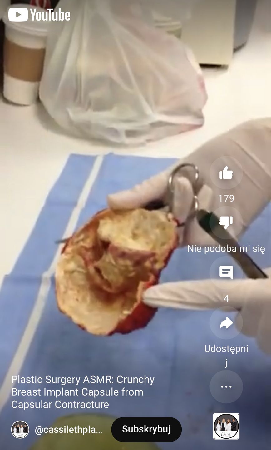 Pokazali, jak wygląda 10-letni implant piersi