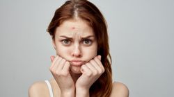 Jak szybko pozbyć się pryszcza? Oto kilka domowych sposobów