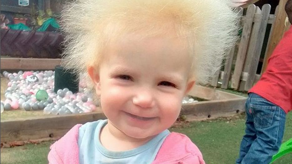 Syndrom nieuczesanych włosów spowodowany jest mutacją genową