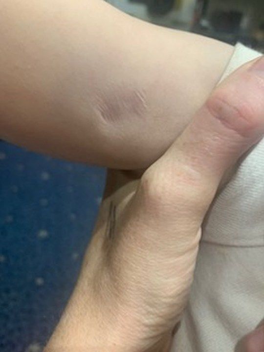 Blizna po ukąszeniu