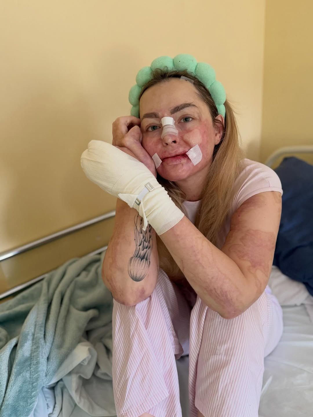 Tiktokerka, która płonęła żywcem, przeszła kolejną operację