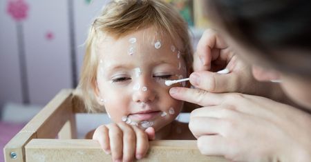 Błędy, które popełniają rodzice, kiedy ich dzieci mają ospę