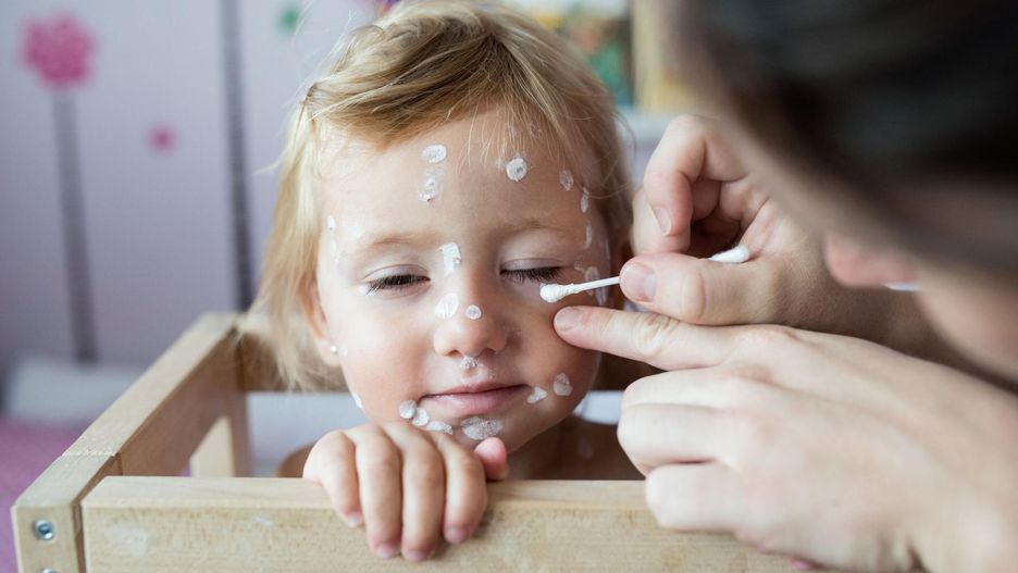 Błędy, które popełniają rodzice, kiedy ich dzieci mają ospę